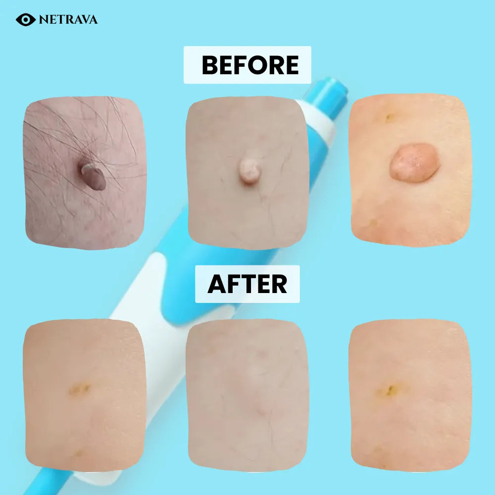 2-in-1 At-Home Skin Tag Remover Kit