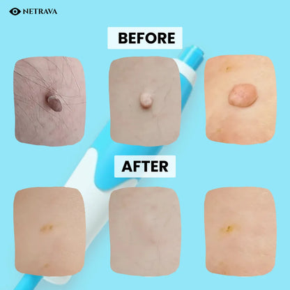 2-in-1 At-Home Skin Tag Remover Kit