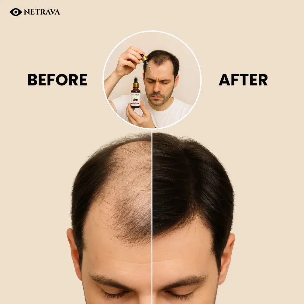 Jamalgota Ayurvedic Hair Growth Oil – 30ml Pack Of 2 | Hair Regrowth & Scalp Nourishment | 100% Natural - NETRAVA